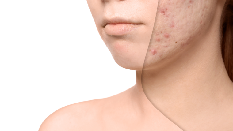 ACNE SCARRING – WHAT YOU NEED TO KNOW